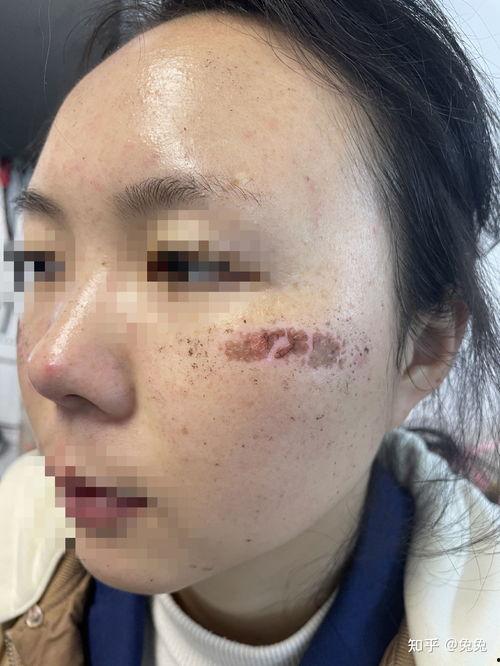 光子嫩肤视频全过程